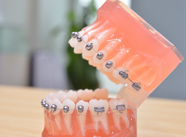 暑假来临学生哥矫正牙齿热潮牙医专家支招走出误区